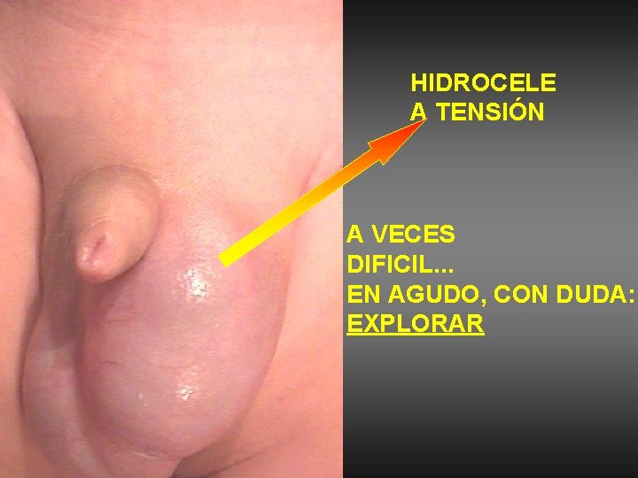 HIDROCELE A TENSIÓN A VECES DIFICIL. . . EN AGUDO, CON DUDA: EXPLORAR 