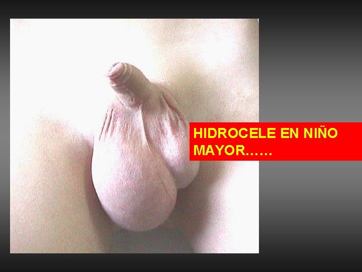 HIDROCELE EN NIÑO MAYOR…… 