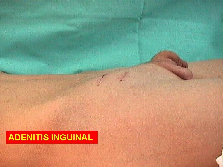 ADENITIS INGUINAL 