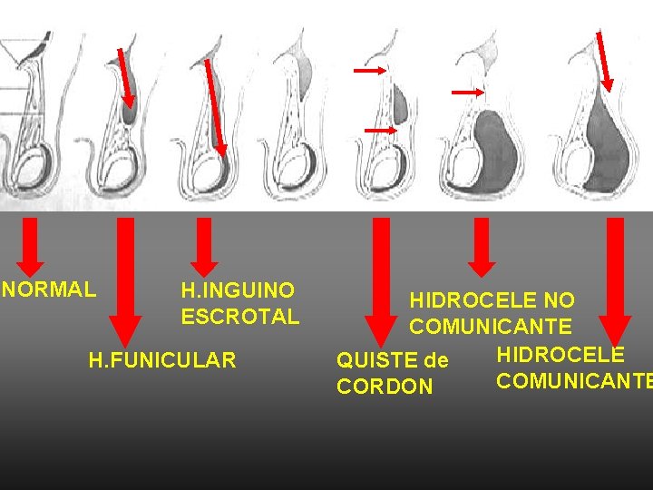 NORMAL H. INGUINO ESCROTAL H. FUNICULAR HIDROCELE NO COMUNICANTE HIDROCELE QUISTE de COMUNICANTE CORDON