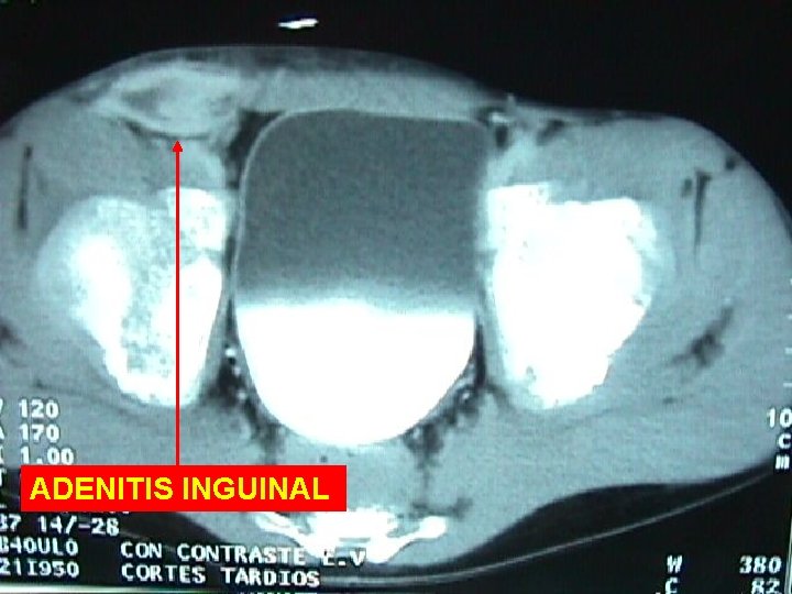 ADENITIS INGUINAL 