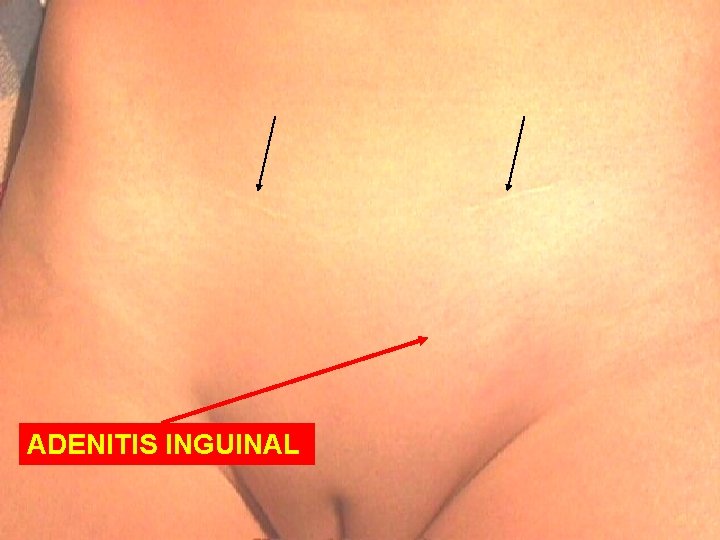 ADENITIS INGUINAL 