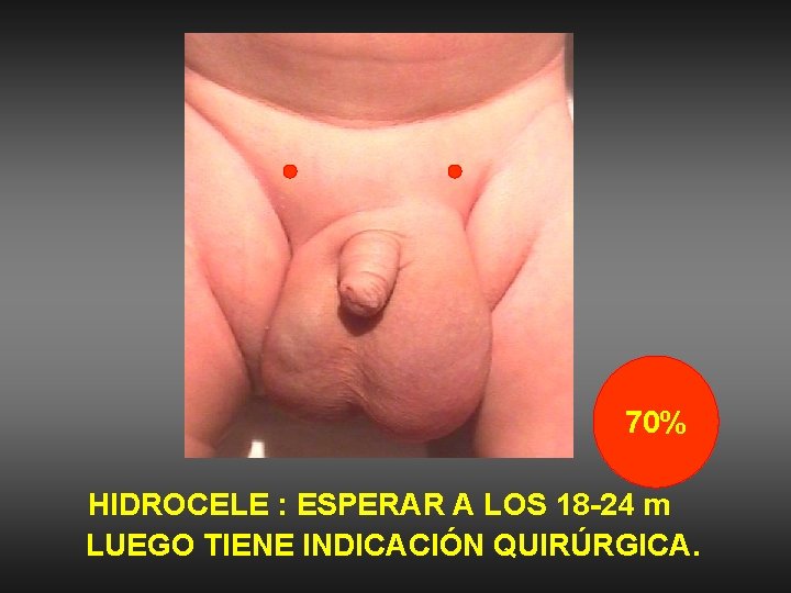 70% HIDROCELE : ESPERAR A LOS 18 -24 m LUEGO TIENE INDICACIÓN QUIRÚRGICA. 