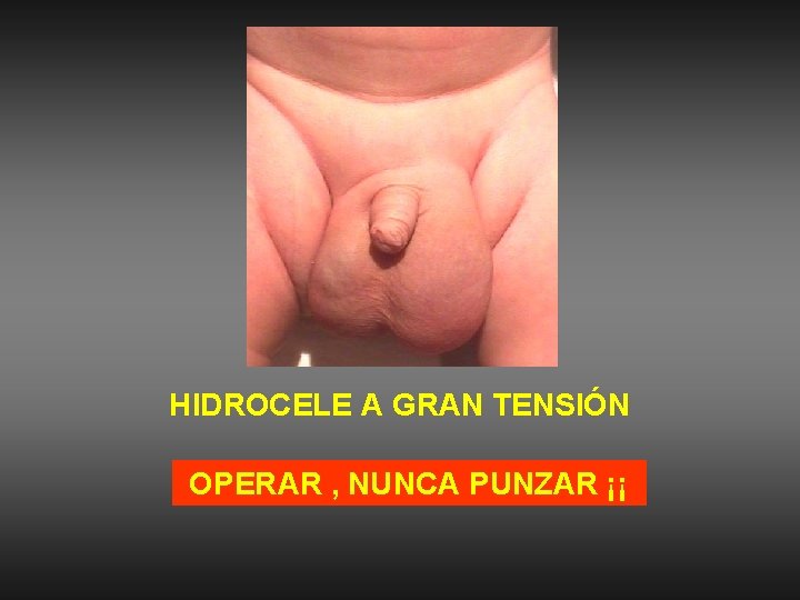 HIDROCELE A GRAN TENSIÓN OPERAR , NUNCA PUNZAR ¡¡ 