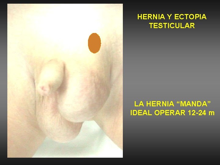 HERNIA Y ECTOPIA TESTICULAR LA HERNIA “MANDA” IDEAL OPERAR 12 -24 m 