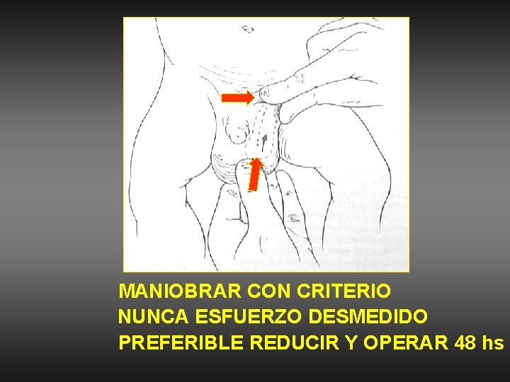 MANIOBRAR CON CRITERIO NUNCA ESFUERZO DESMEDIDO PREFERIBLE REDUCIR Y OPERAR 48 hs 