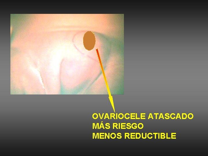 OVARIOCELE ATASCADO MÁS RIESGO MENOS REDUCTIBLE 