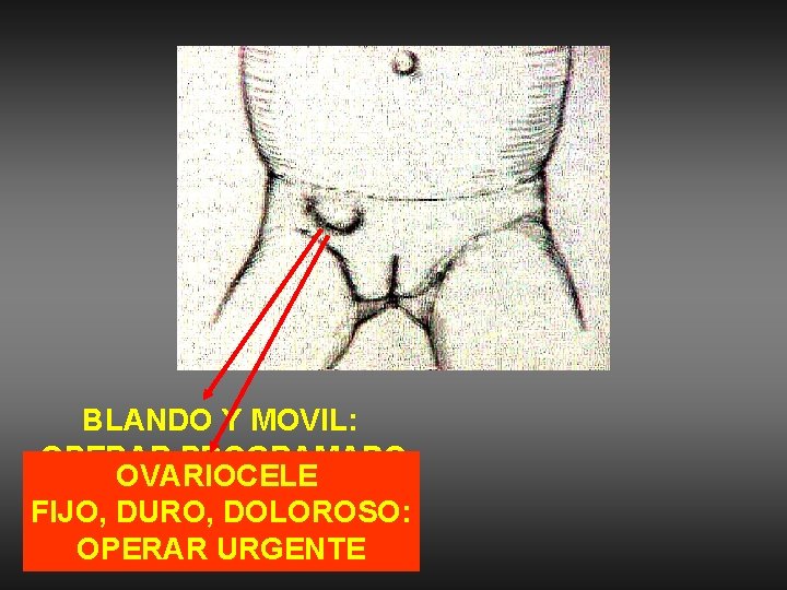 BLANDO Y MOVIL: OPERAR PROGRAMADO OVARIOCELE FIJO, DURO, DOLOROSO: OPERAR URGENTE 