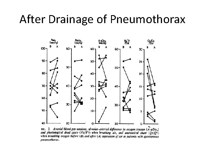 After Drainage of Pneumothorax 