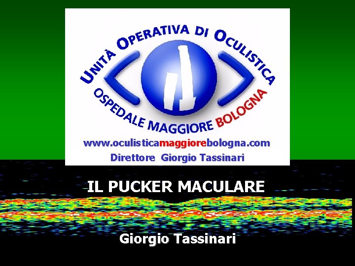 www. oculisticamaggiorebologna. com Direttore Giorgio Tassinari IL PUCKER MACULARE Giorgio Tassinari 