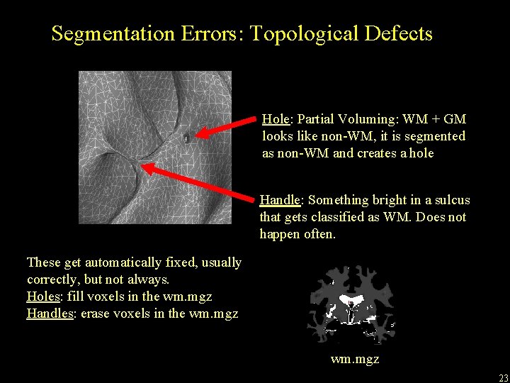 Segmentation Errors: Topological Defects Hole: Partial Voluming: WM + GM looks like non-WM, it