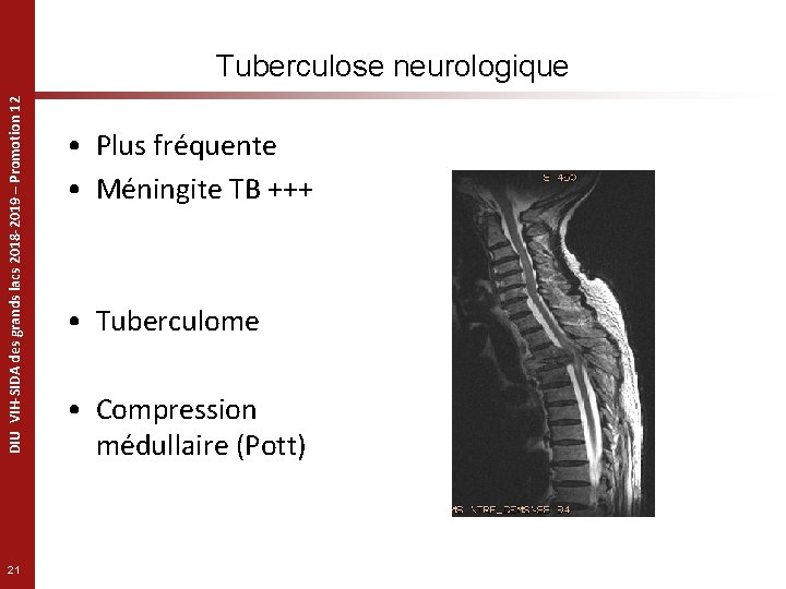 DIU VIH-SIDA des grands lacs 2018 -2019 – Promotion 12 Tuberculose neurologique 21 •