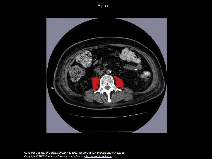 Figure 1 Canadian Journal of Cardiology 2017 331652 -1659 DOI: (10. 1016/j. cjca. 2017.