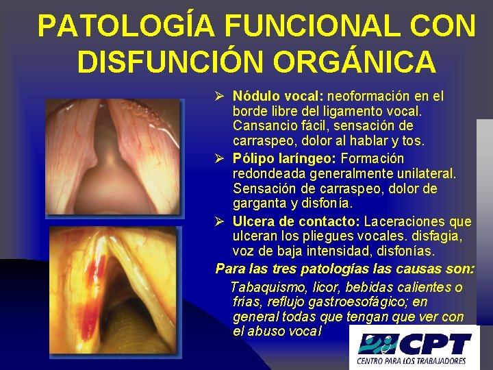 PATOLOGÍA FUNCIONAL CON DISFUNCIÓN ORGÁNICA Ø Nódulo vocal: neoformación en el borde libre del