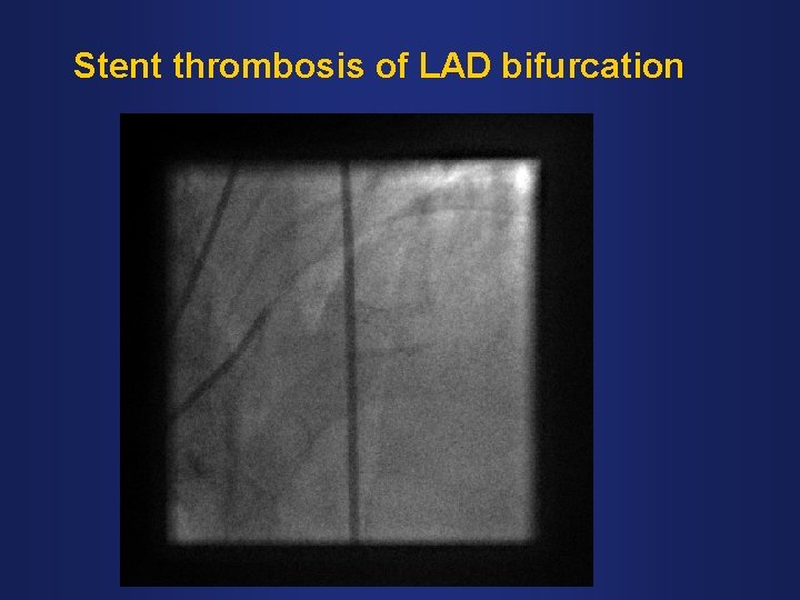 Stent thrombosis of LAD bifurcation 