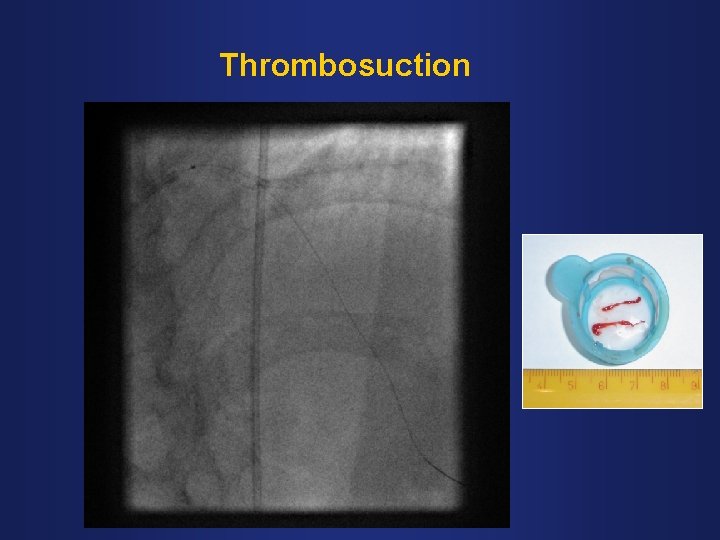 Thrombosuction 