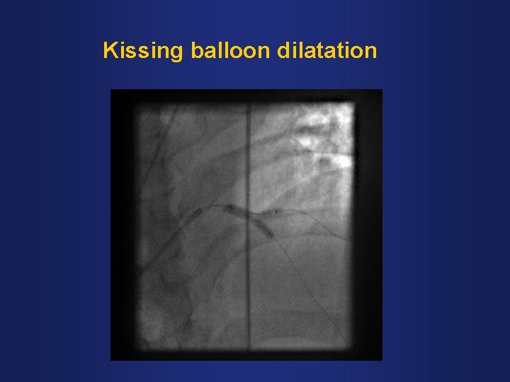 Kissing balloon dilatation 