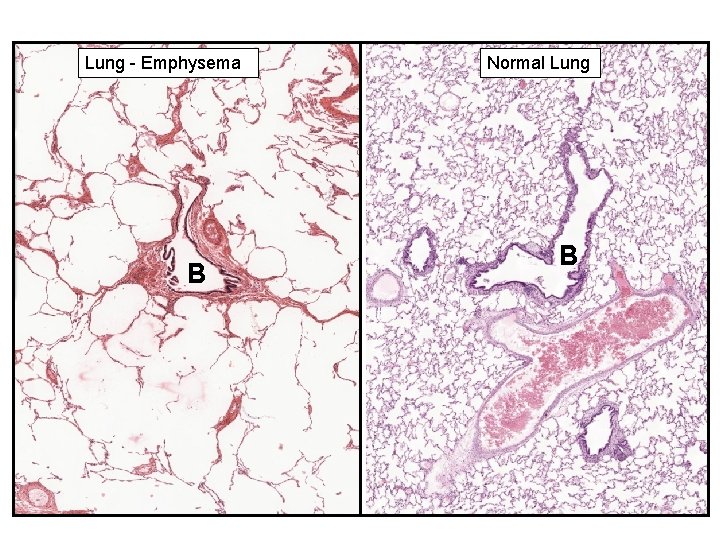 Lung - Emphysema B Normal Lung B 25 