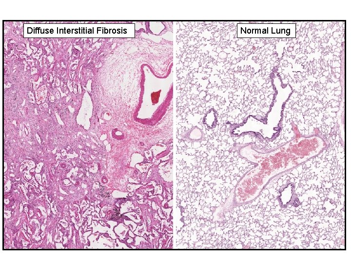 Diffuse Interstitial Fibrosis Normal Lung 26 