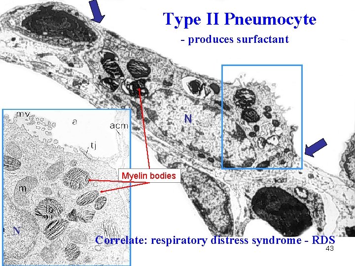 Type II Pneumocyte - produces surfactant N Myelin bodies N Correlate: respiratory distress syndrome