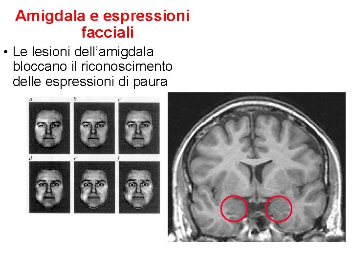 Amigdala e espressioni facciali • Le lesioni dell’amigdala bloccano il riconoscimento delle espressioni di Amigdala e espressioni facciali • Le lesioni dell’amigdala bloccano il riconoscimento delle espressioni di