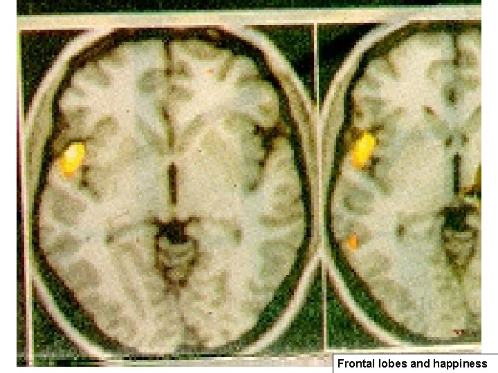 Frontal lobes and happiness Frontal lobes and happiness