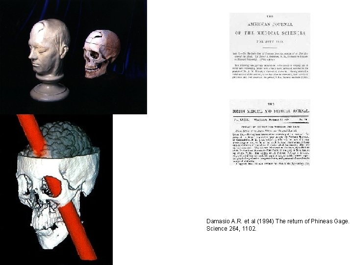 Damasio A. R. et al (1994) The return of Phineas Gage. Science 264, 1102. Damasio A. R. et al (1994) The return of Phineas Gage. Science 264, 1102.