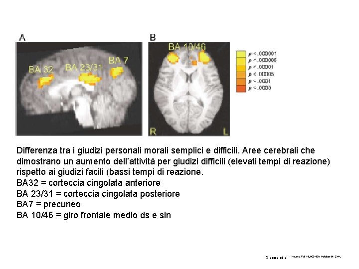 Differenza tra i giudizi personali morali semplici e difficili. Aree cerebrali che dimostrano un Differenza tra i giudizi personali morali semplici e difficili. Aree cerebrali che dimostrano un