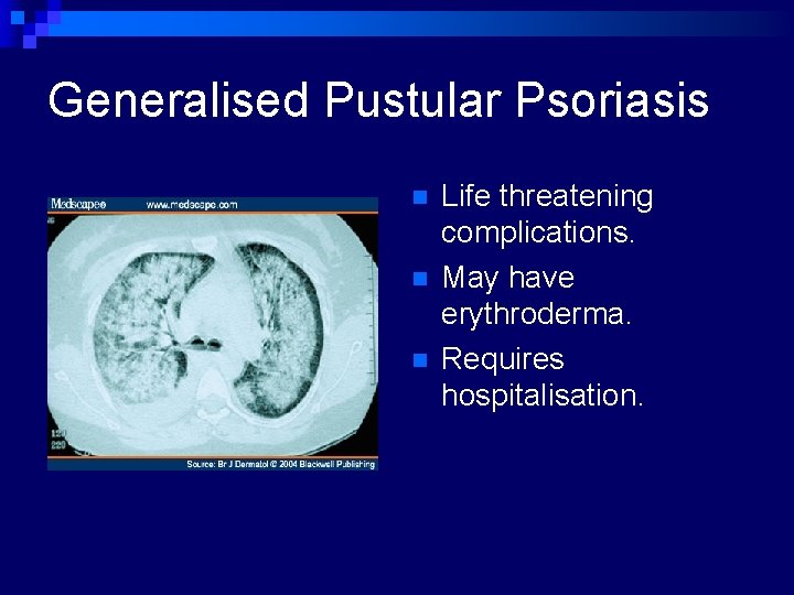 complications of pustular psoriasis