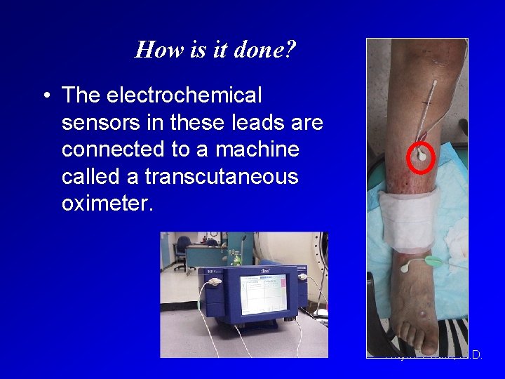 How is it done? • The electrochemical sensors in these leads are connected to
