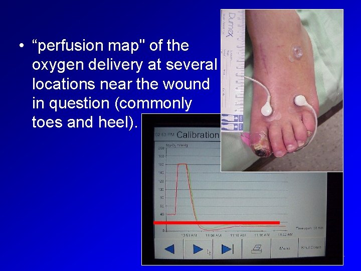  • “perfusion map" of the oxygen delivery at several locations near the wound