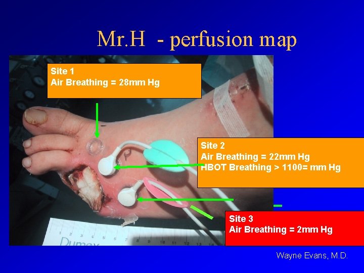 Mr. H - perfusion map Site 1 Air Breathing = 28 mm Hg Site