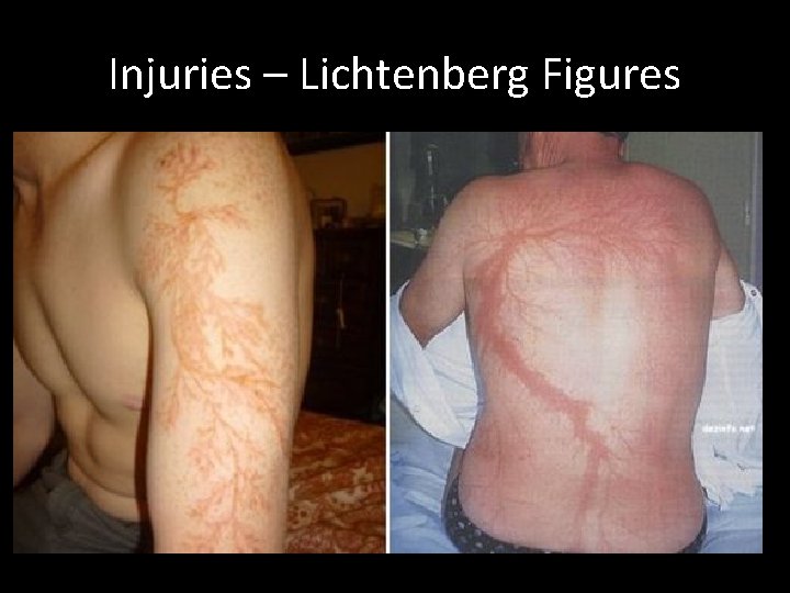 Injuries – Lichtenberg Figures 