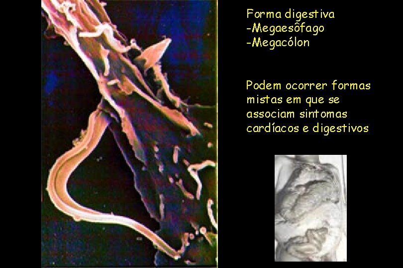 Forma digestiva -Megaesôfago -Megacólon Podem ocorrer formas mistas em que se associam sintomas cardíacos