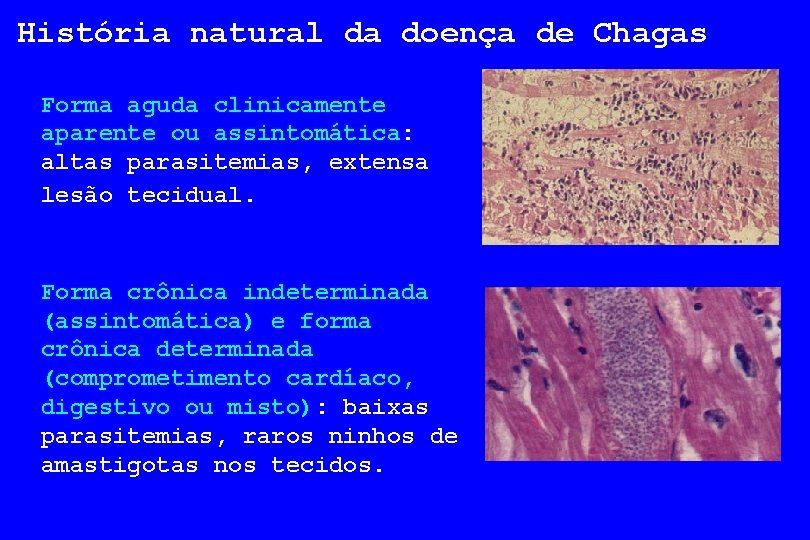 História natural da doença de Chagas Forma aguda clinicamente aparente ou assintomática: altas parasitemias,