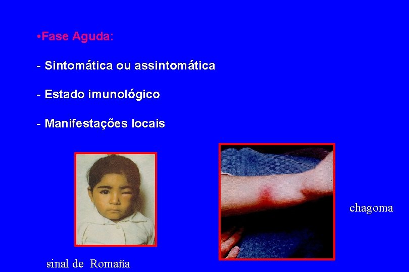  • Fase Aguda: - Sintomática ou assintomática - Estado imunológico - Manifestações locais