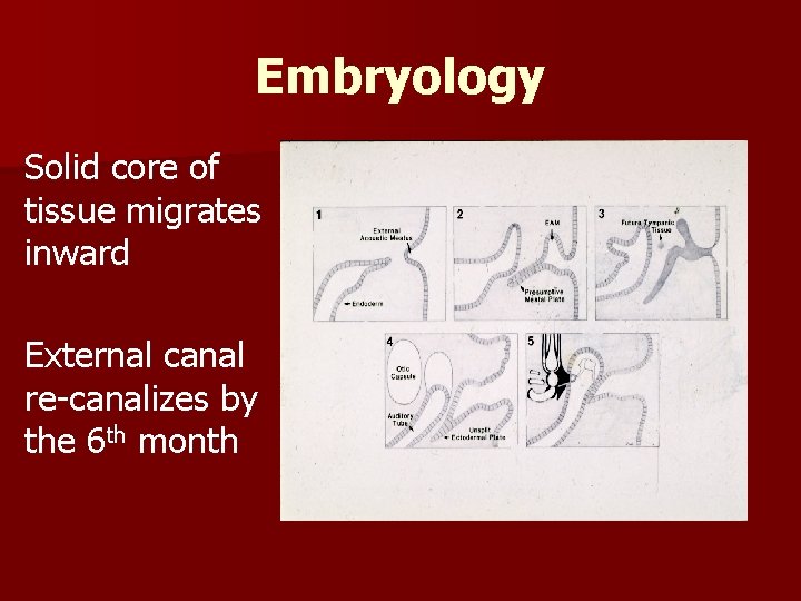 Embryology Solid core of tissue migrates inward External canal re-canalizes by the 6 th