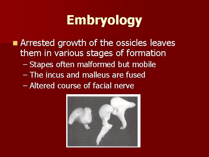 Embryology n Arrested growth of the ossicles leaves them in various stages of formation