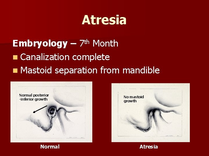 Atresia Embryology – 7 th Month n Canalization complete n Mastoid separation from mandible