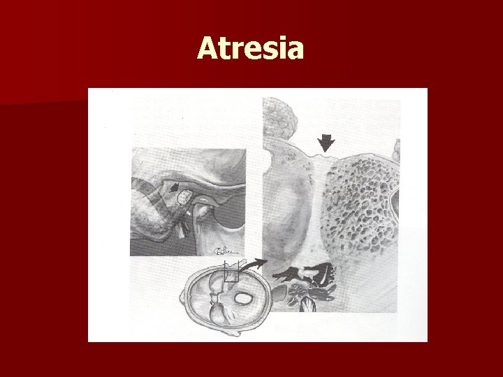 Atresia 