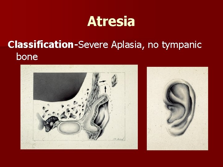 Atresia Classification-Severe Aplasia, no tympanic bone 