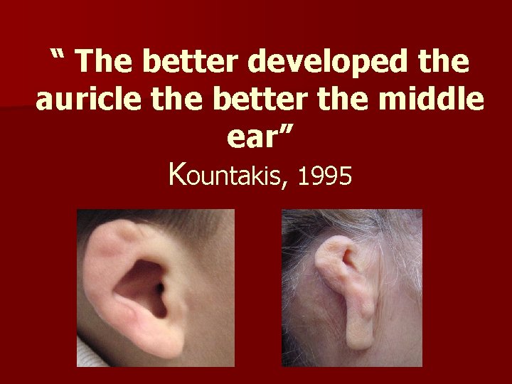 “ The better developed the auricle the better the middle ear” Kountakis, 1995 