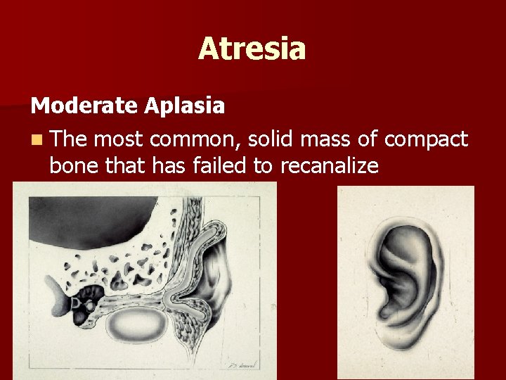 Atresia Moderate Aplasia n The most common, solid mass of compact bone that has