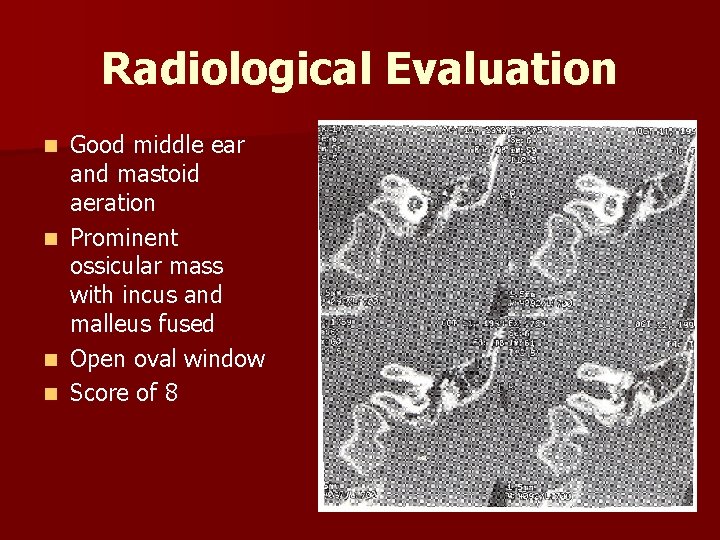 Radiological Evaluation Good middle ear and mastoid aeration n Prominent ossicular mass with incus