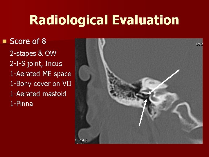 Radiological Evaluation n Score of 8 2 -stapes & OW 2 -I-S joint, Incus