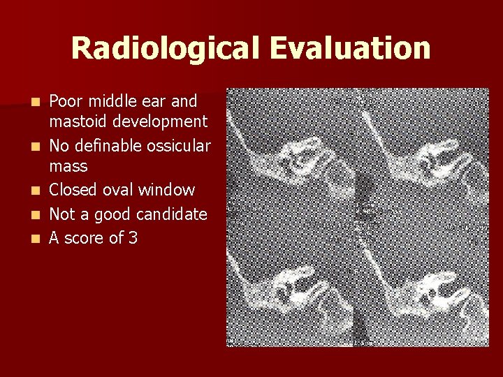 Radiological Evaluation n n Poor middle ear and mastoid development No definable ossicular mass
