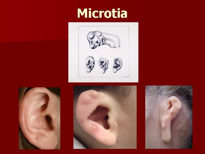 Microtia 