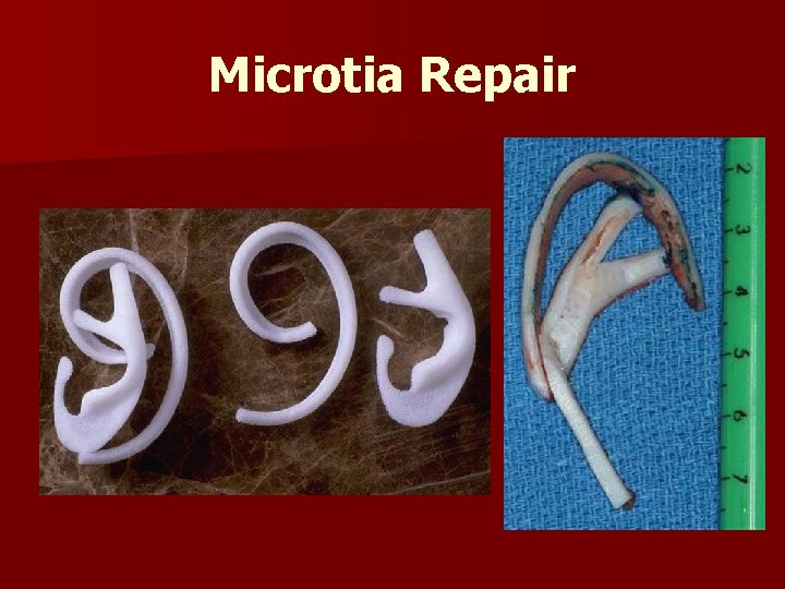 Microtia Repair 