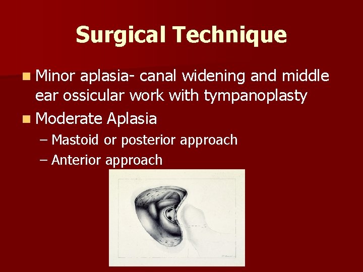 Surgical Technique n Minor aplasia- canal widening and middle ear ossicular work with tympanoplasty