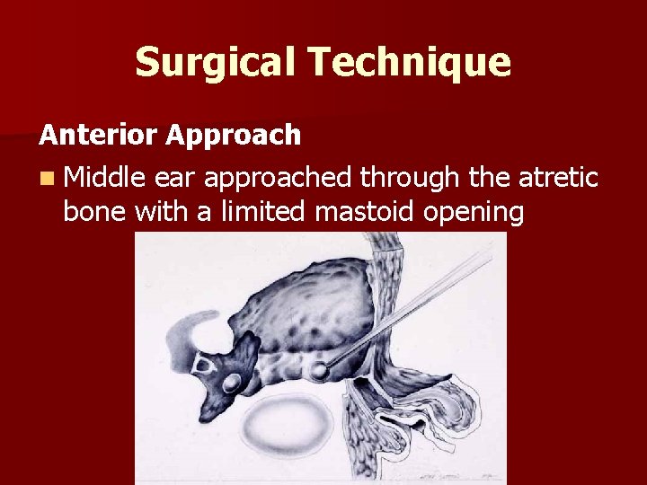 Surgical Technique Anterior Approach n Middle ear approached through the atretic bone with a
